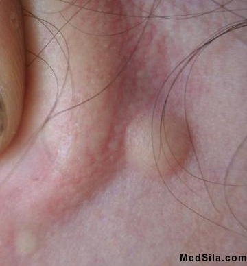 Липома